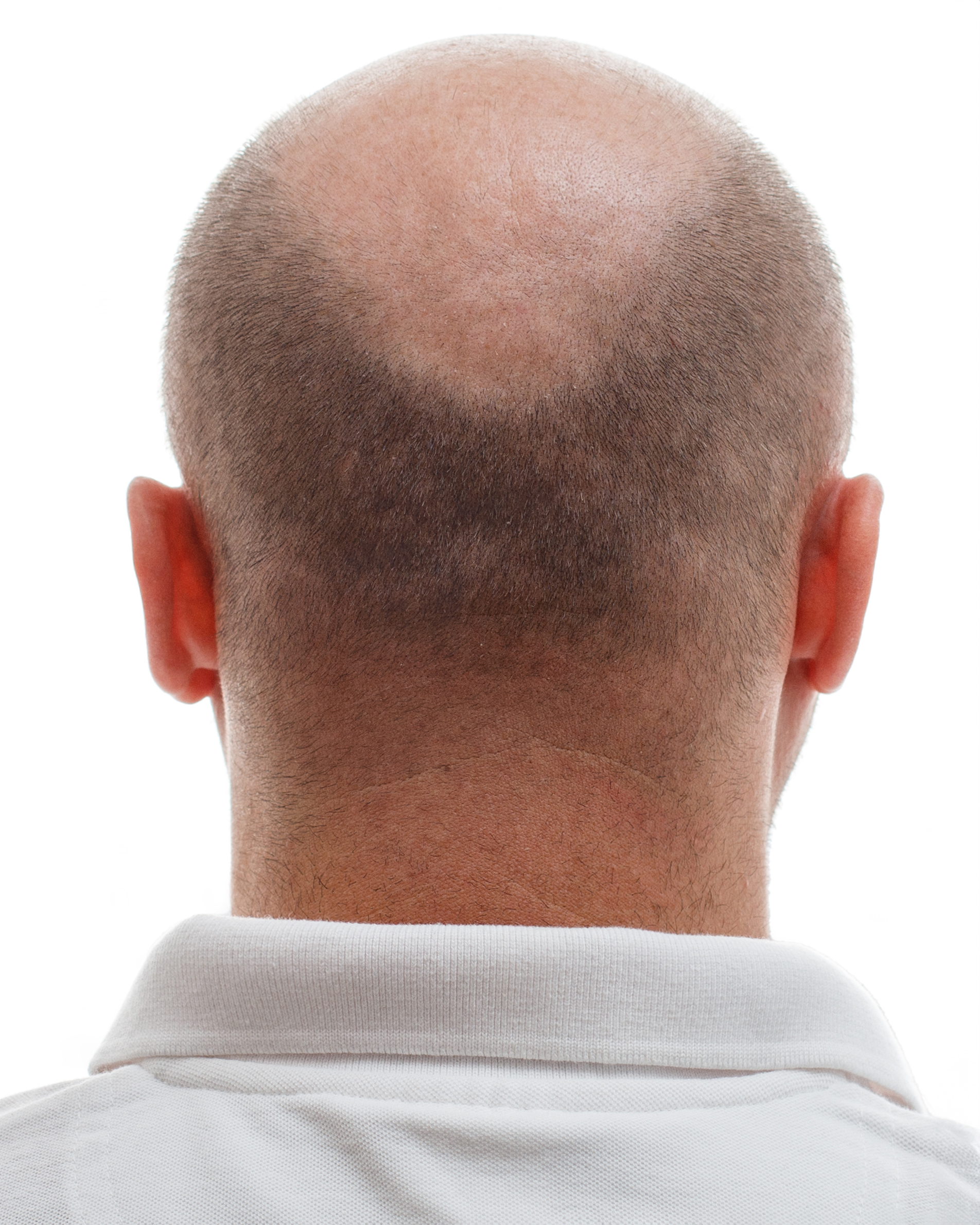 Head Balding Man Before